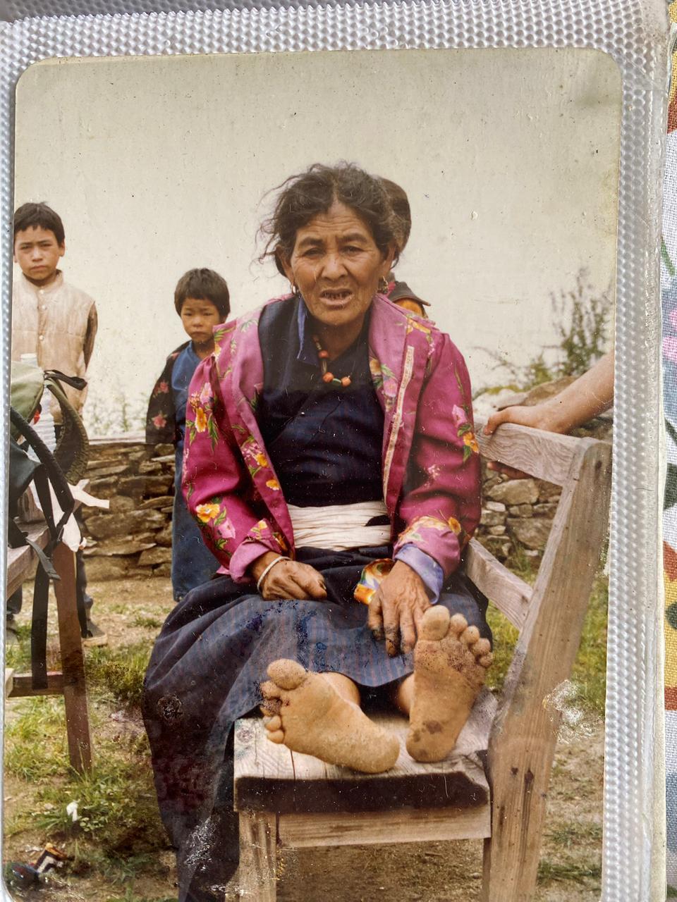 Cataract Surgery Mission Dhunche Nepal